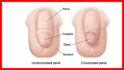 Adult Circumcision